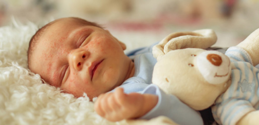 Infantile-Eczema-All-you-need-to-know